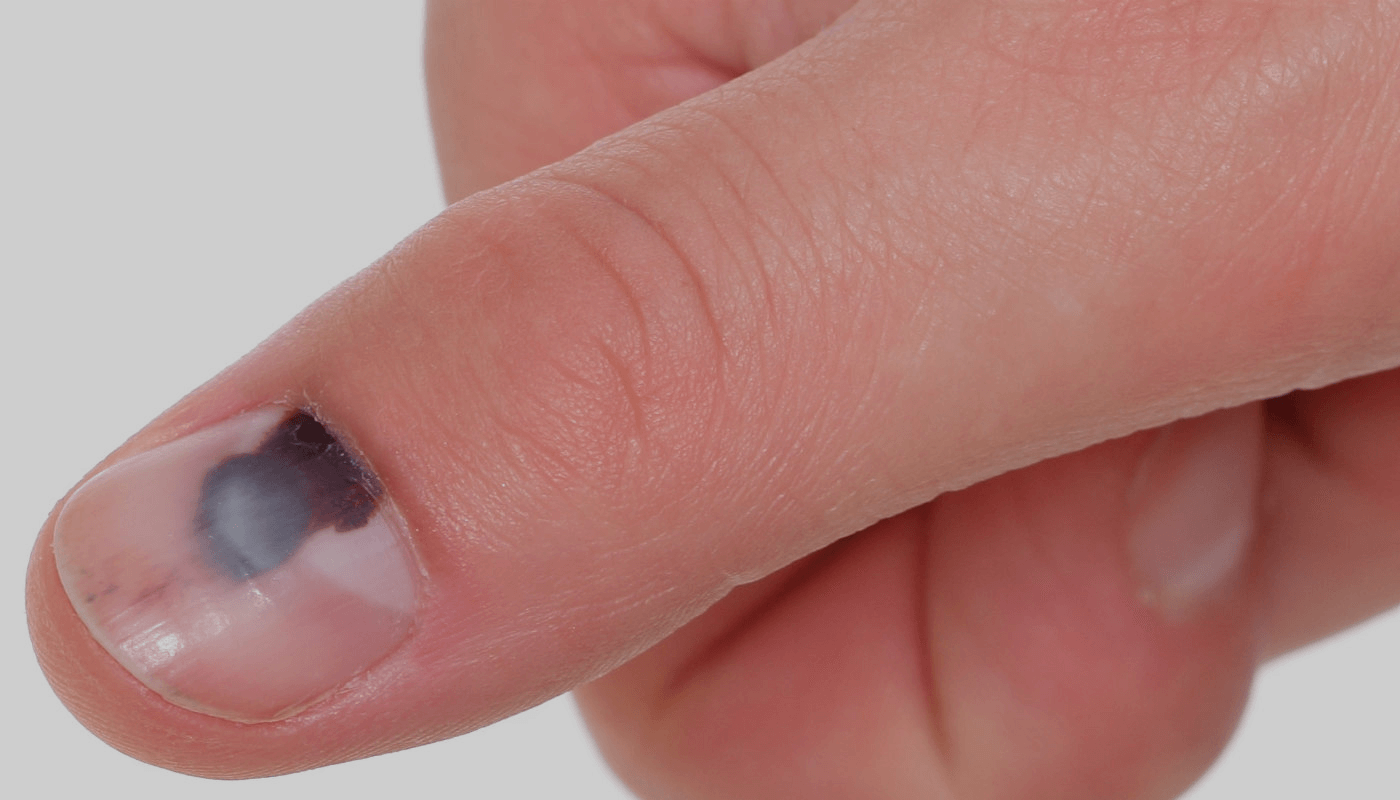 Dermatoscopia e Biópsia: Como o Diagnóstico Precoce Salva Vidas no Melanoma de Unha