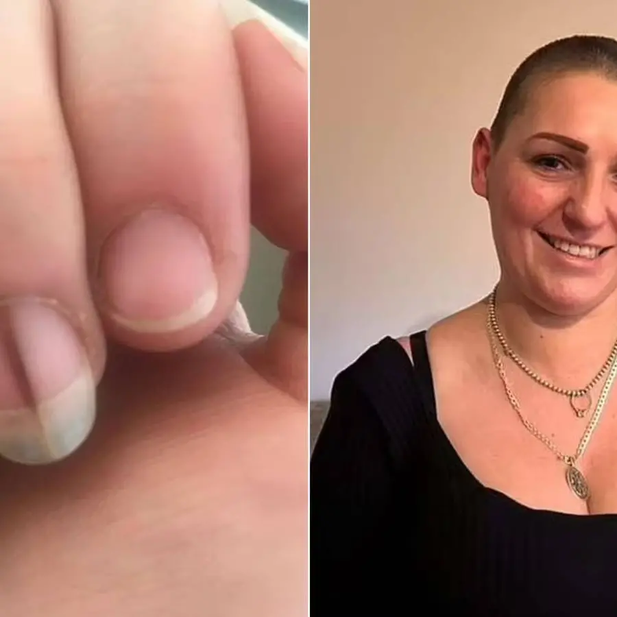 Melanoníquia: Causas Benignas e Quando Se Preocupar com a Linha Escura na Unha