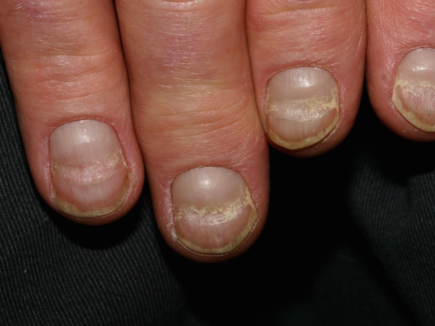 linhas verticais nas unhas causas
