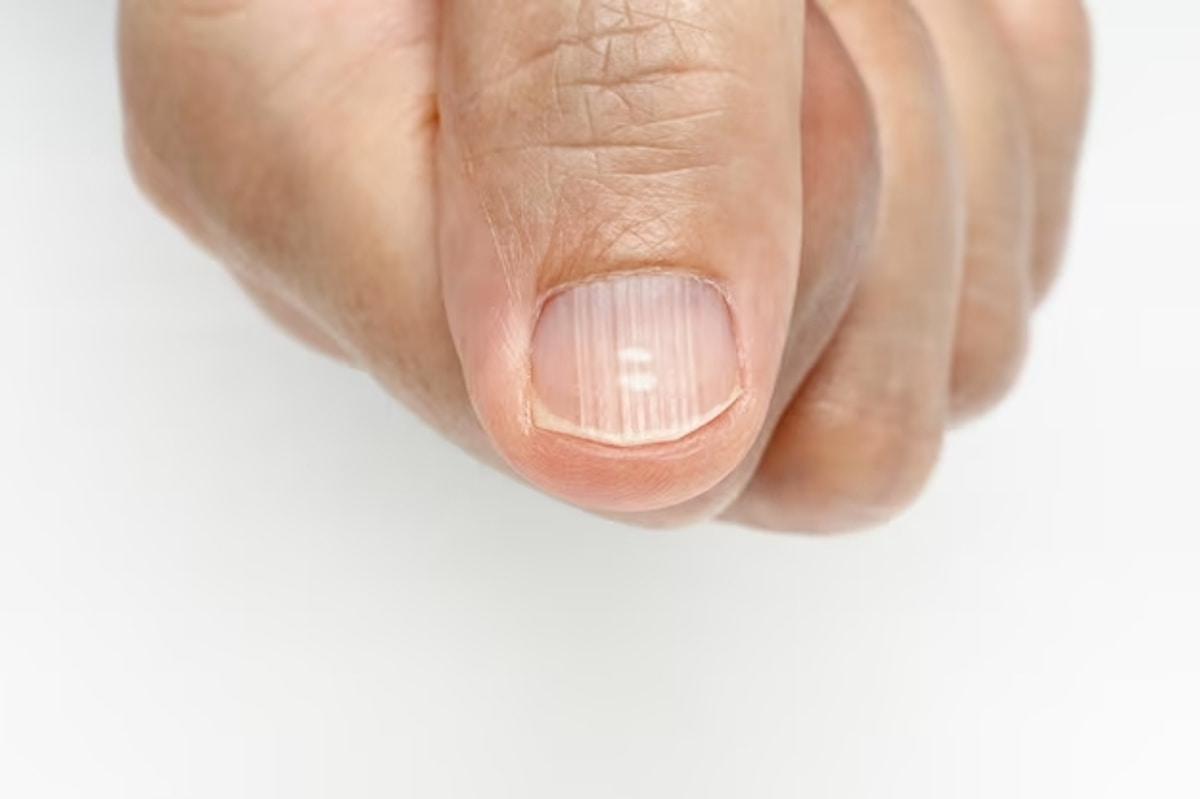 unhas estriadas e quebradiças