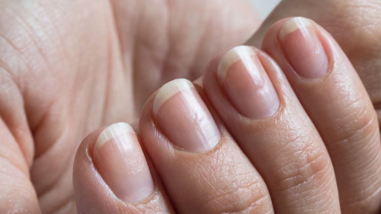 unhas com sulcos