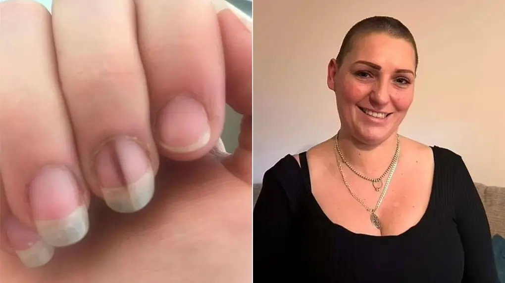 Trauma na Unha vs. Melanoma: Como Diferenciar a Mancha Escura