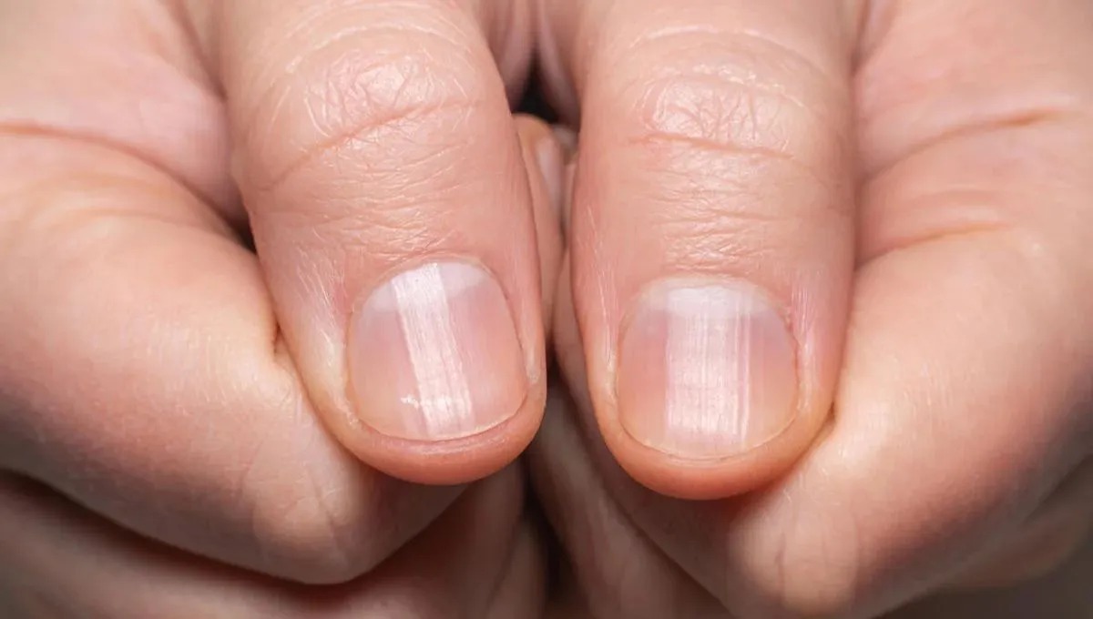 Melanoma Ungueal: Sinais de Alerta e a Importância do Diagnóstico Precoce