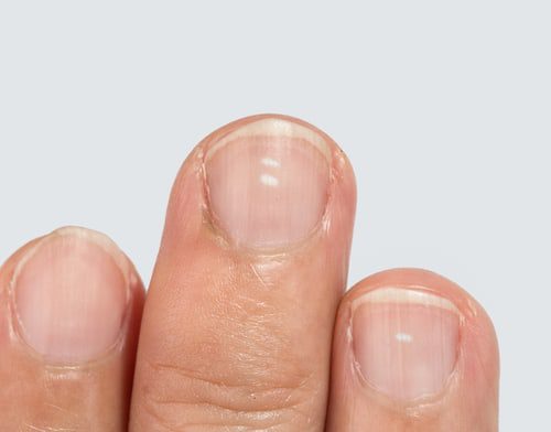 Tratamentos e Prevenção de Manchas Brancas nas Unhas.
