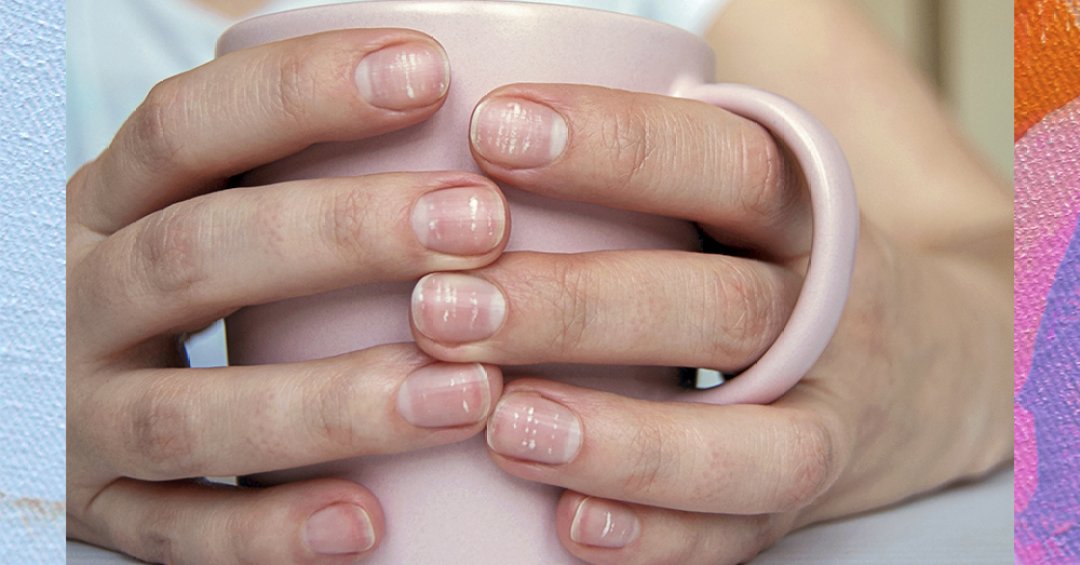 Como Identificar e Tratar Manchas Brancas nas Unhas Causadas por Traumas