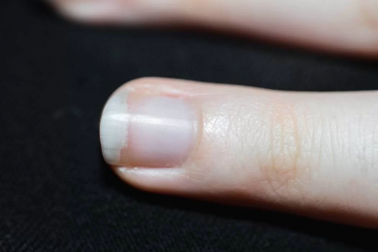 Quando as Manchas Brancas nas Unhas Indicam um Problema de Saúde?