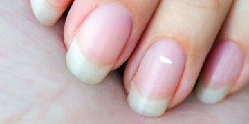 Guia Completo: Causas, Sintomas e Prevenção de Manchas Brancas nas Unhas