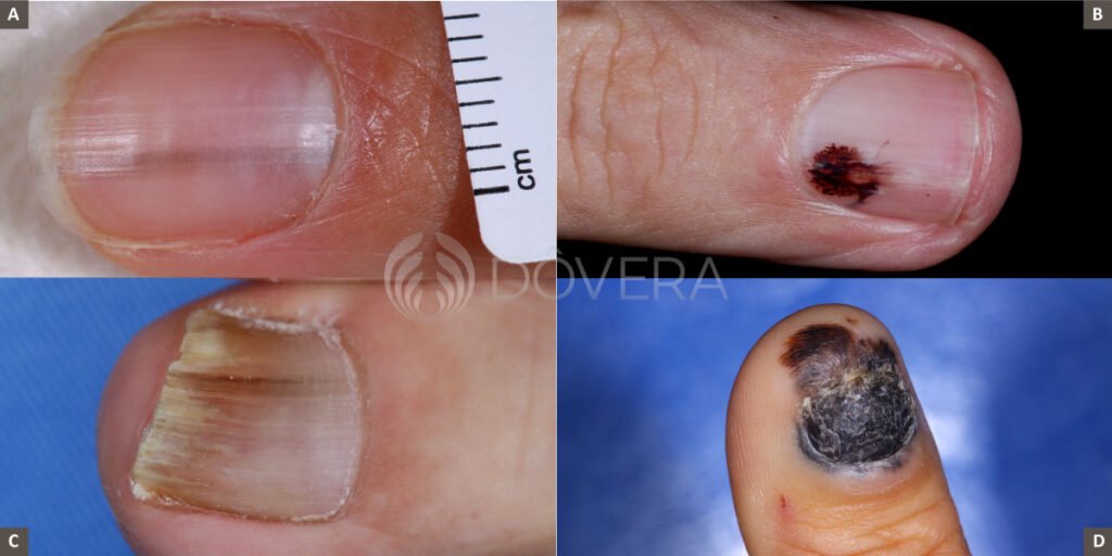 Melanoníquia Benigna vs. Melanoma Ungueal: Como Diferenciar Manchas Escuras na Unha