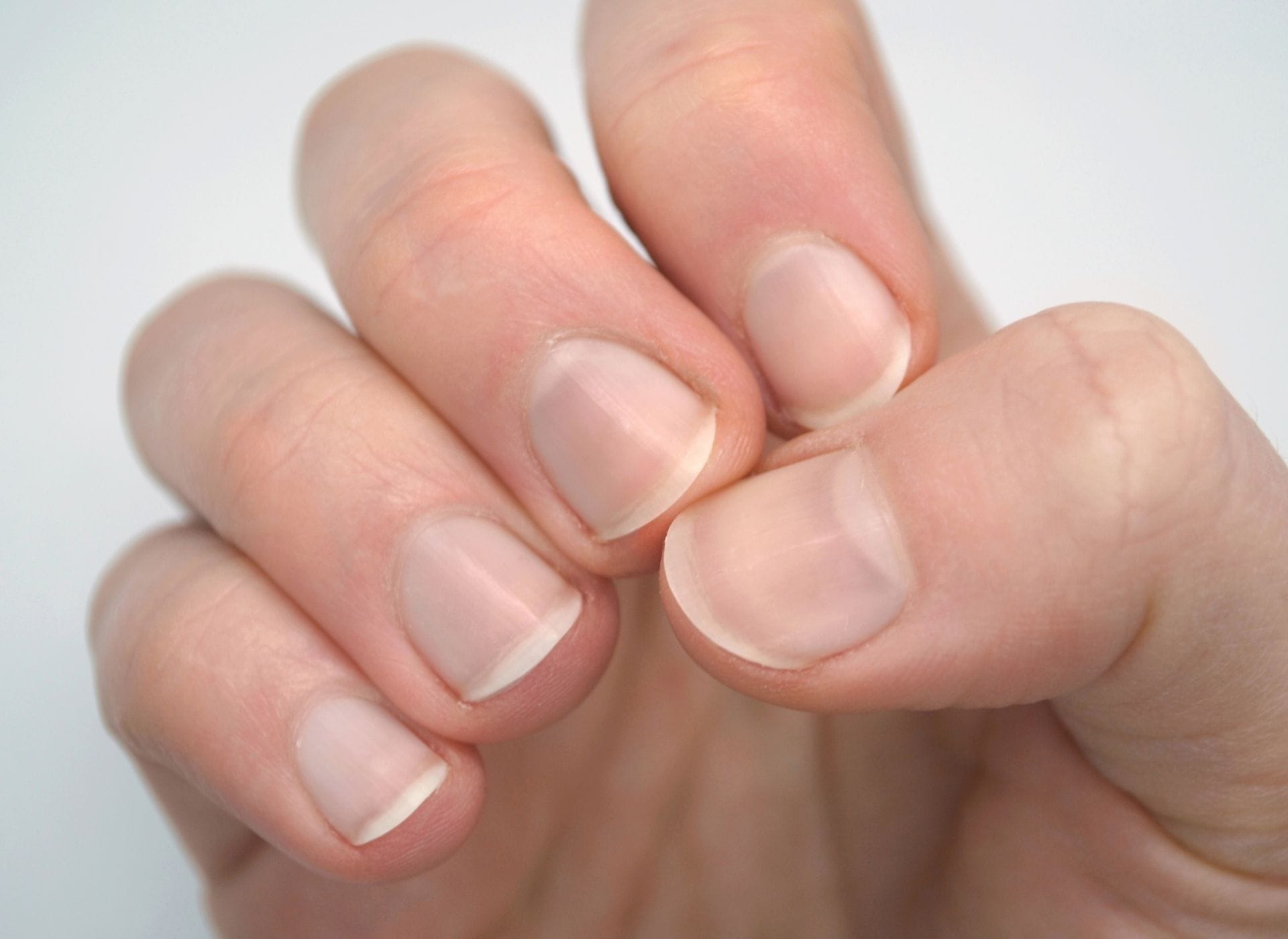 Tratamentos e Prevenção; Melanoma Ungueal: Sinais de Alerta e Quando Procurar um Médico; Manchas Escuras nas Unhas: Trauma vs. Problemas de Saúde Mais Graves; Micose de Unha: Como Identificar e Tratar Manchas Amareladas; Deficiências Nutricionais e Suas Manifestações nas Unhas