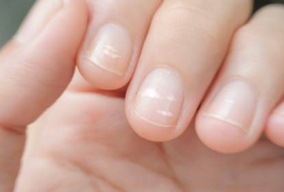 tipos de manchas brancas nas unhas e como tratar