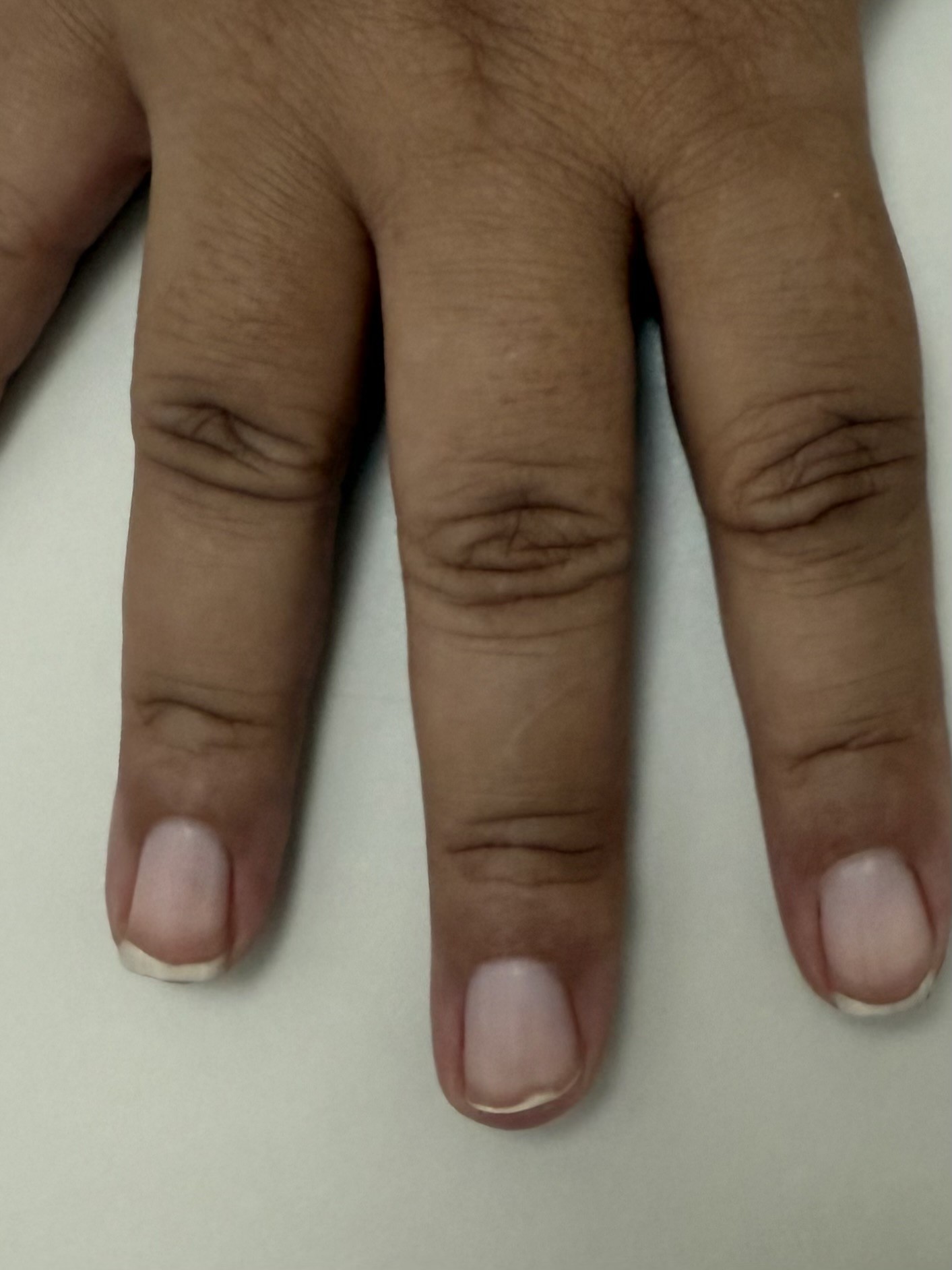Dermatologista: O Profissional Certo para Diagnosticar Manchas nas Unhas