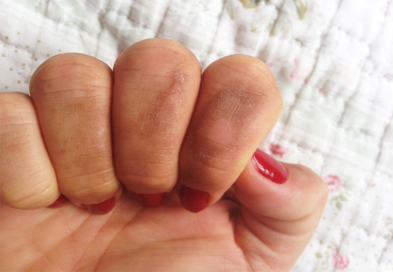 Manchas Brancas na Unha: Causas Comuns e Quando se Preocupar