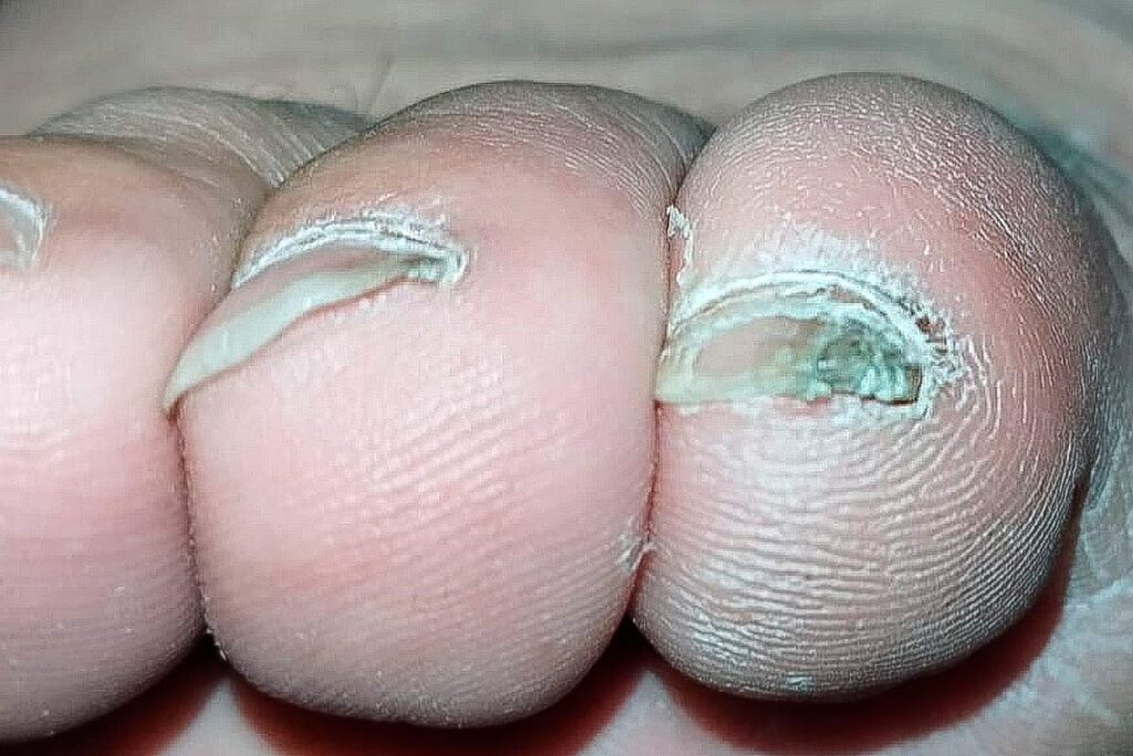 mancha escura na unha do dedão