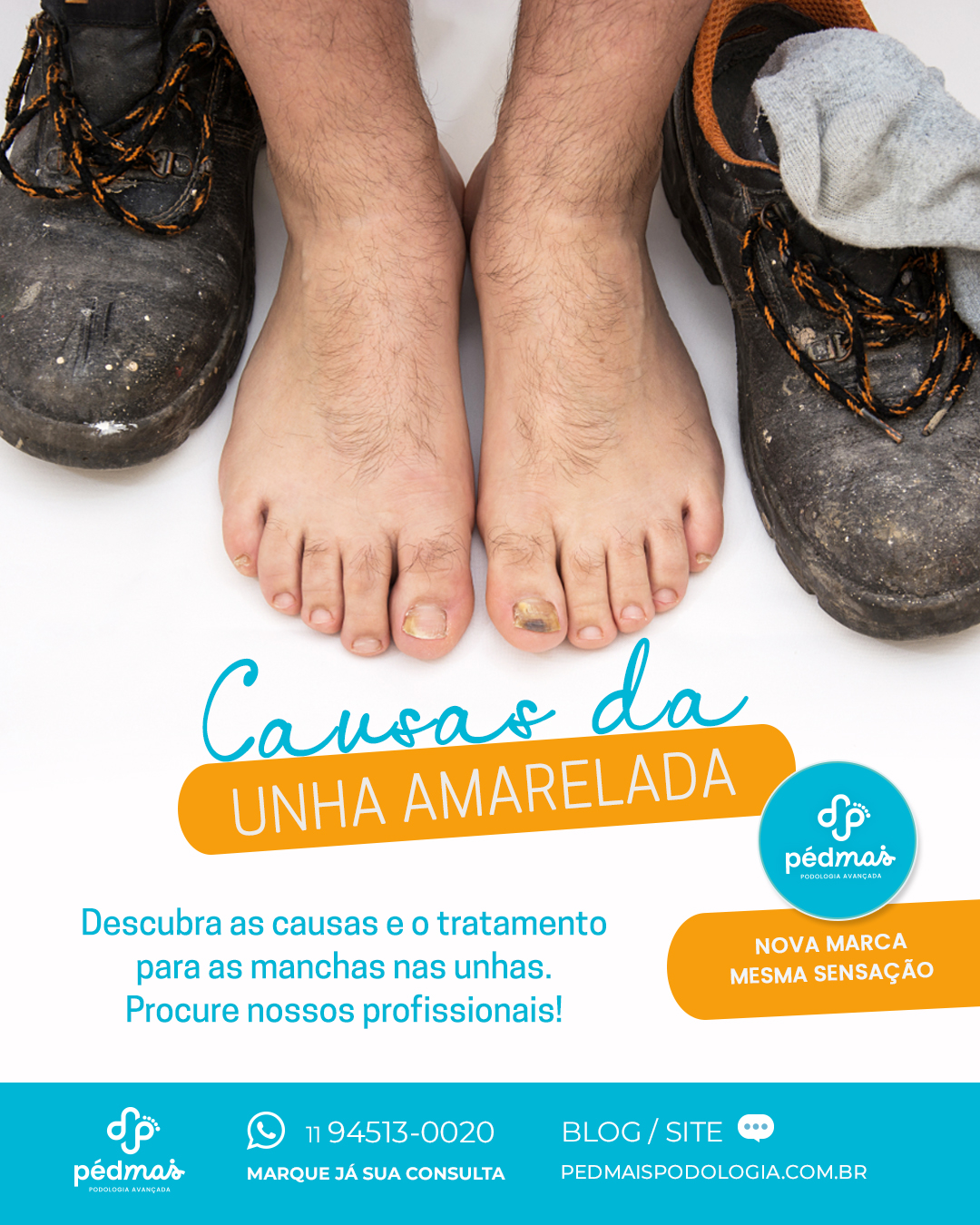 Manchas Escuras na Unha: Causas, Sinais de Alerta e Quando Procurar um Médico