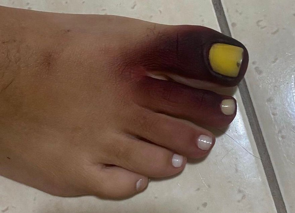 unha do pé preta