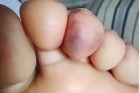 fungo na unha do dedão roxa