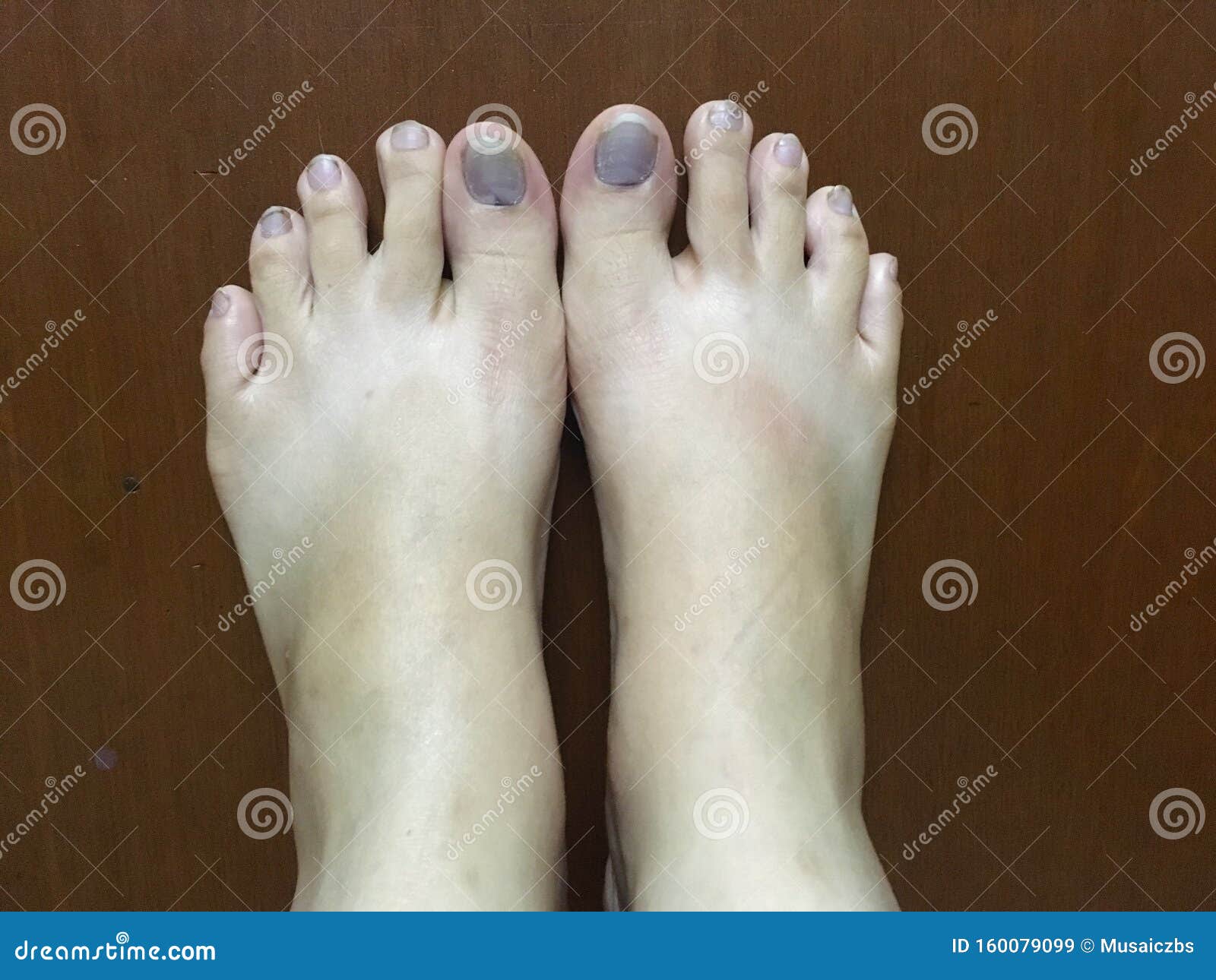 tratamento unha roxa pé