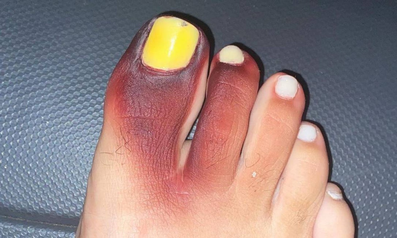 melanoma ungueal dedão