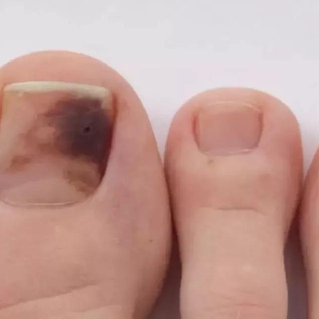 hematoma subungueal dedão do pé