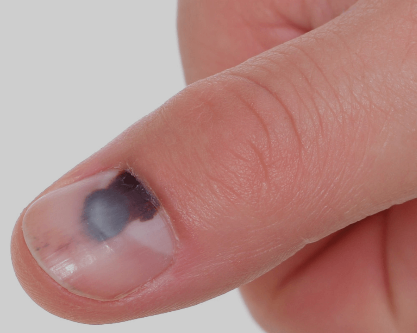 tipos de manchas vermelhas nas unhas e suas causas