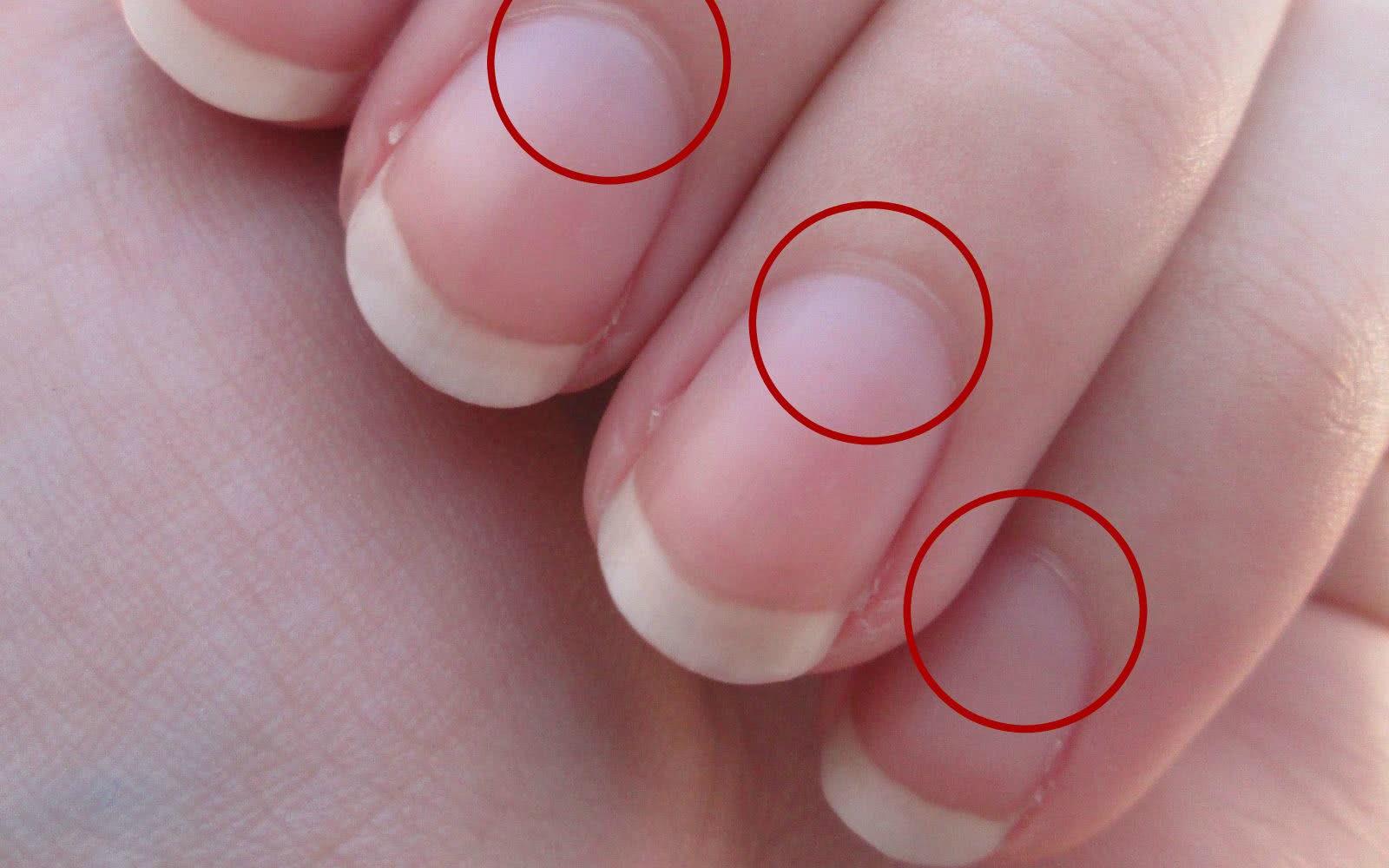 Como Prevenir Manchas Brancas nas Unhas: Guia Completo