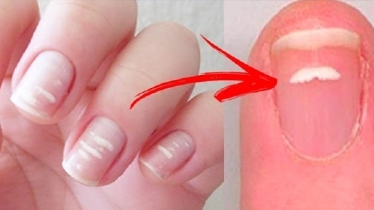 Mitos e Verdades sobre a Leuconíquia