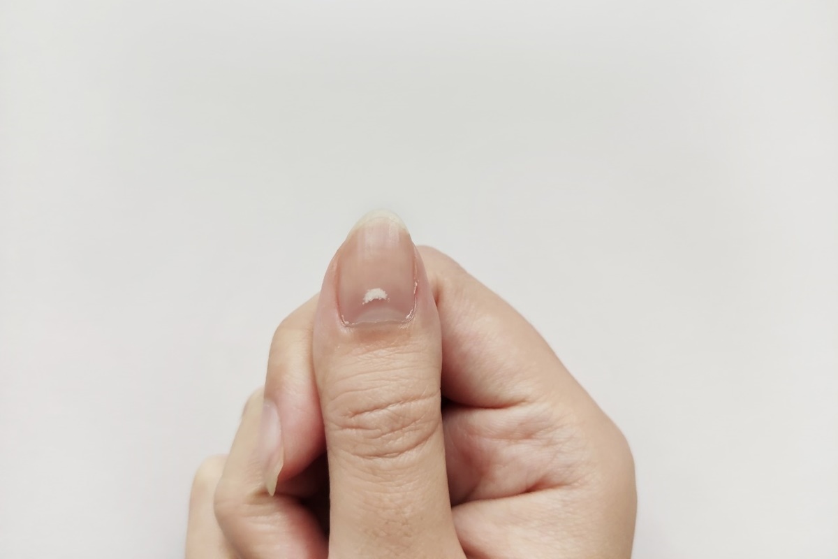 manchas nas unhas e dor
