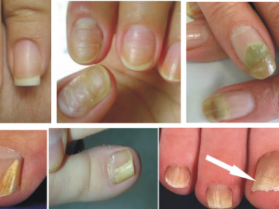 manchas nas unhas podem ser sinal de doença