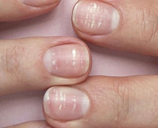 como tratar manchas nas unhas