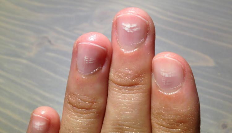 O que são manchas brancas nas unhas e quando se preocupar?