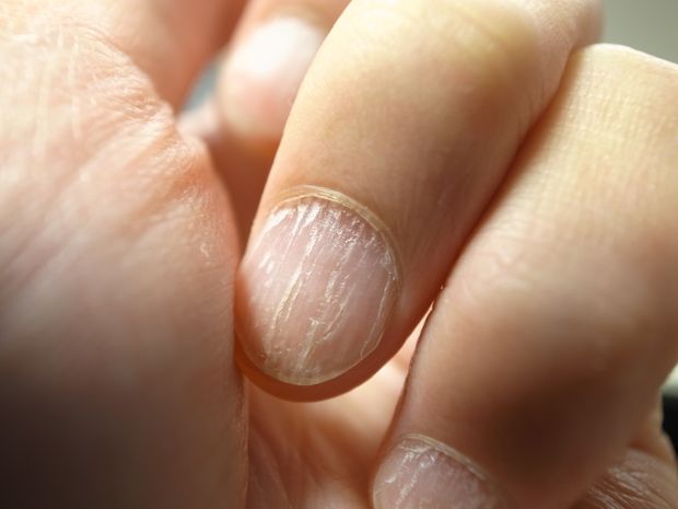 O que são manchas brancas nas unhas e quando se preocupar?