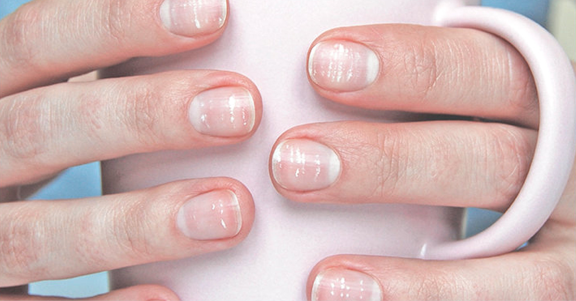 Alergias e Esmaltes: A relação com as manchas brancas ungueais.