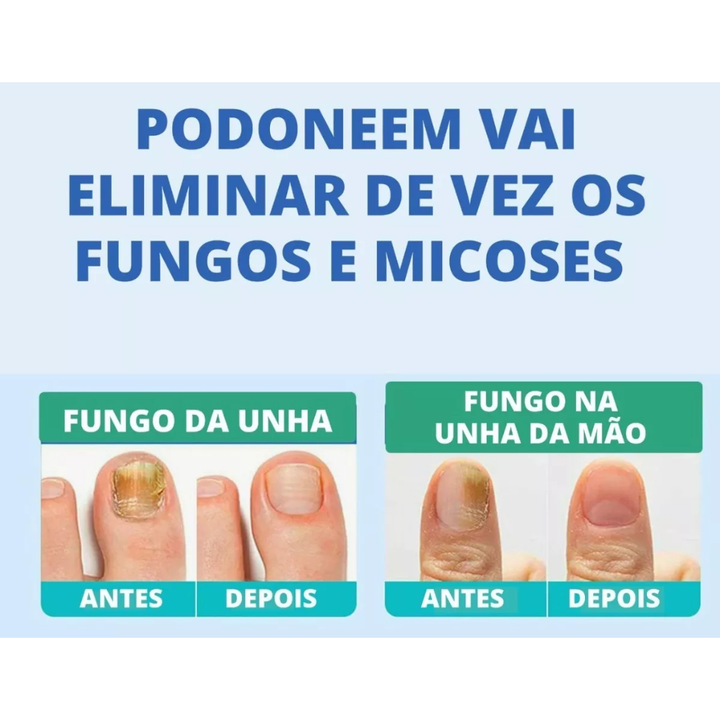 sintomas micose unha mão