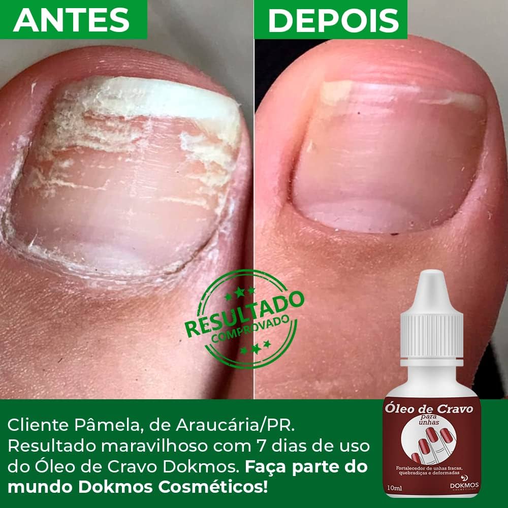 melaleuca unha fraca