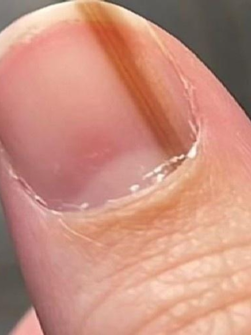 Biópsia da unha: O que esperar do diagnóstico de melanoma