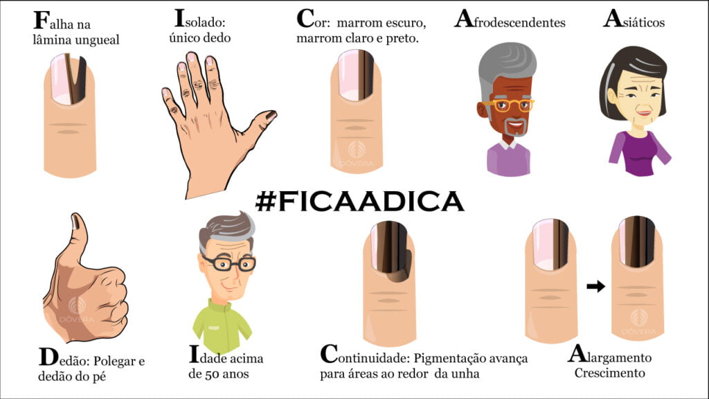 Melanoma Subungueal: Um Guia Completo de Sintomas e Diagnóstico