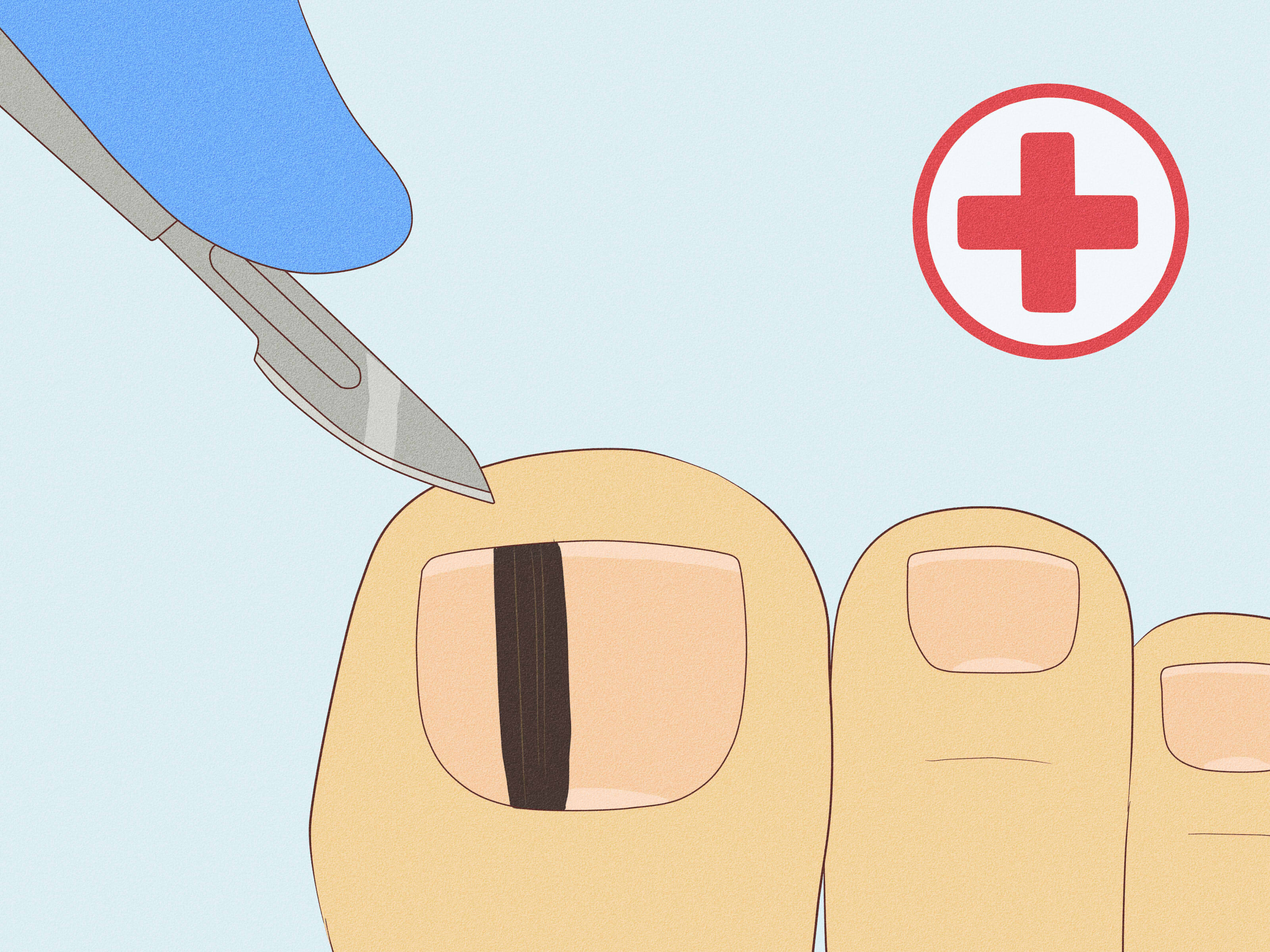 Tratamento Cirúrgico do Melanoma Ungueal: Opções e Prognóstico