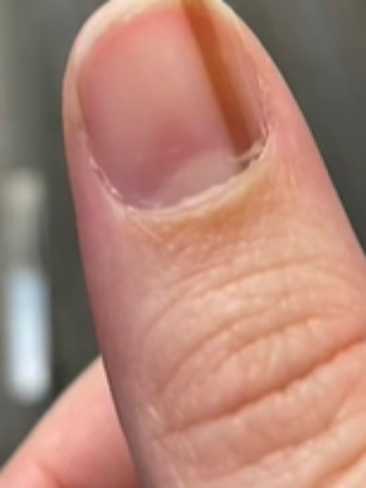 Melanoma Subungueal: Um Guia Completo de Sintomas e Diagnóstico