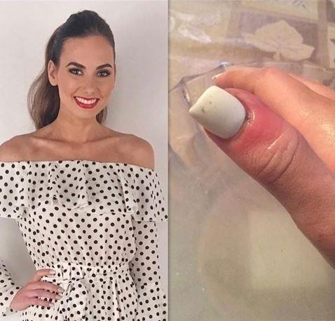 Como Diferenciar Melanoma Ungueal de Micose e Hematoma