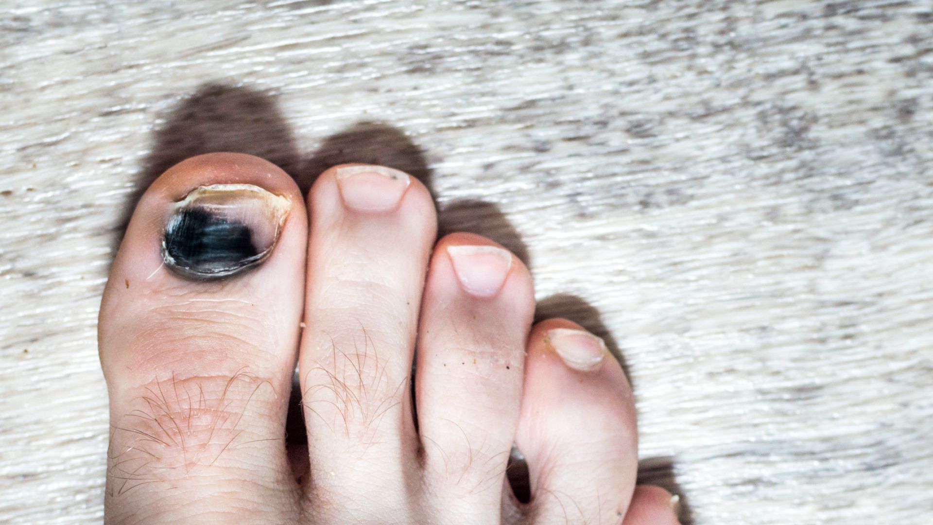 Como Diferenciar Melanoma Ungueal de Micose e Hematoma