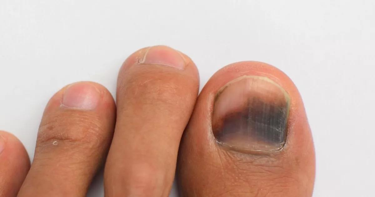 A Importância da Biópsia na Detecção Precoce do Melanoma na Unha