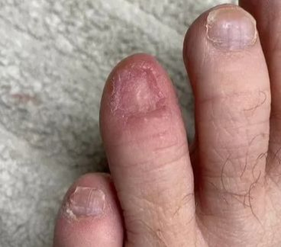 Fatores de Risco e Prevenção do Melanoma na Unha: O Que Você Precisa Saber