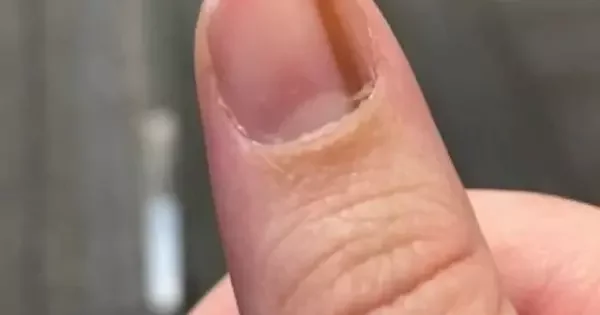 melanoma na unha do pé