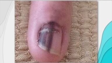 Melanoma Subungueal: Um Guia Completo de Sintomas e Diagnóstico