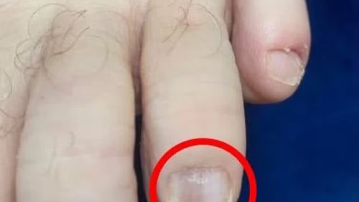 Câncer de Unha: Entenda os Sinais Visuais e a Importância da Avaliação Médica