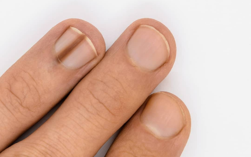 Desvendando o Sinal de Hutchinson: O Alerta Crucial do Melanoma Ungueal