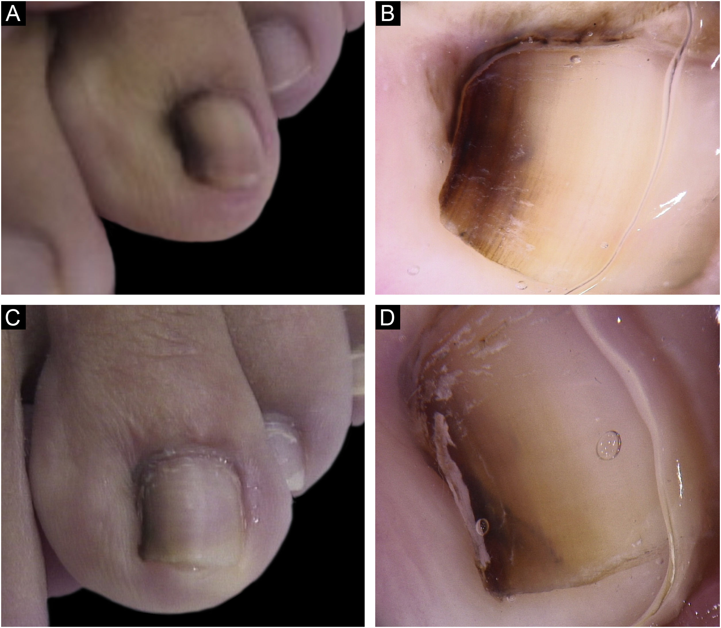 Micose ou Melanoma na Unha? Saiba Como Distinguir e Agir