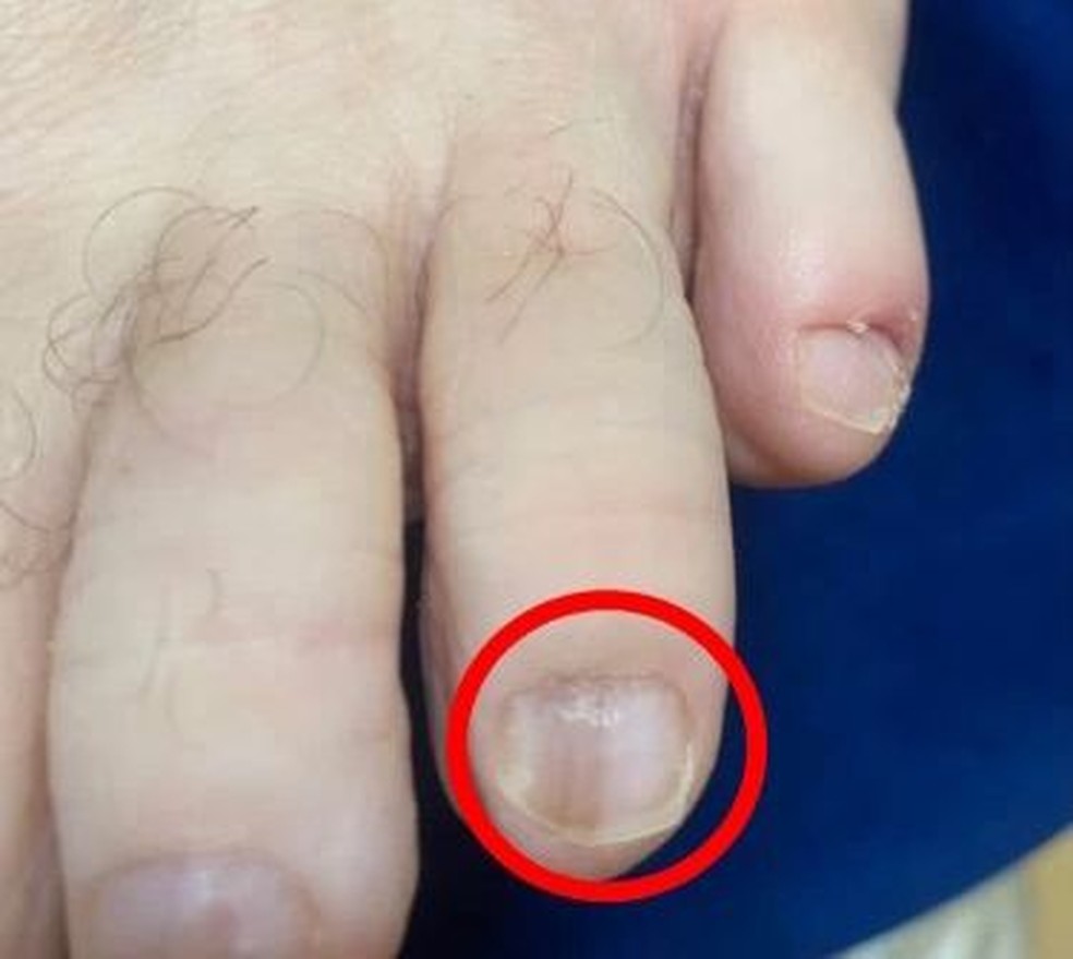 Câncer de Unha: Entenda os Sinais Visuais e a Importância da Avaliação Médica