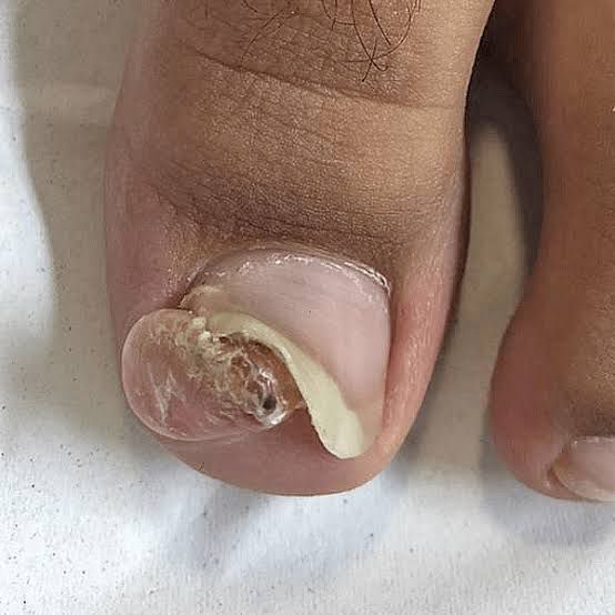 Micose ou Melanoma na Unha? Saiba Como Distinguir e Agir