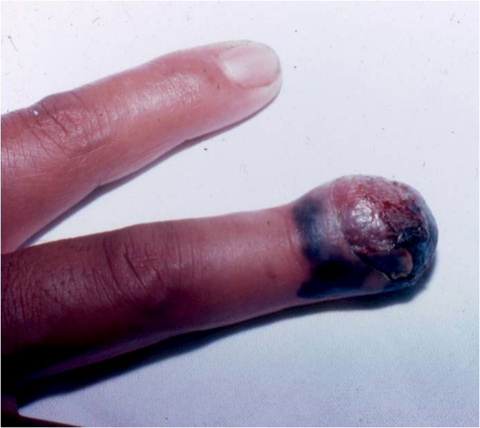 5 ideias de títulos:
1. Melanoma Ungueal: Entendendo os Sinais e a Importância do Diagnóstico Precoce
2. A Cura do Melanoma na Unha: Fatores que Influenciam o Tratamento
3. Melanoma Ungueal: Quando Procurar um Especialista e Quais os Sinais de Alerta?
4. Cirurgia no Melanoma Ungueal: Procedimentos e Recuperação
5. Melanoma na Unha: Mitos e Verdades sobre a Doença e sua Cura